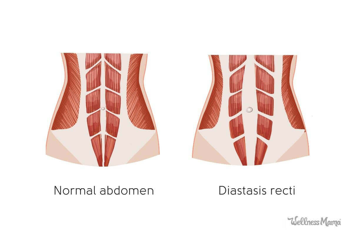 How to Identify and Fix Diastasis Recti