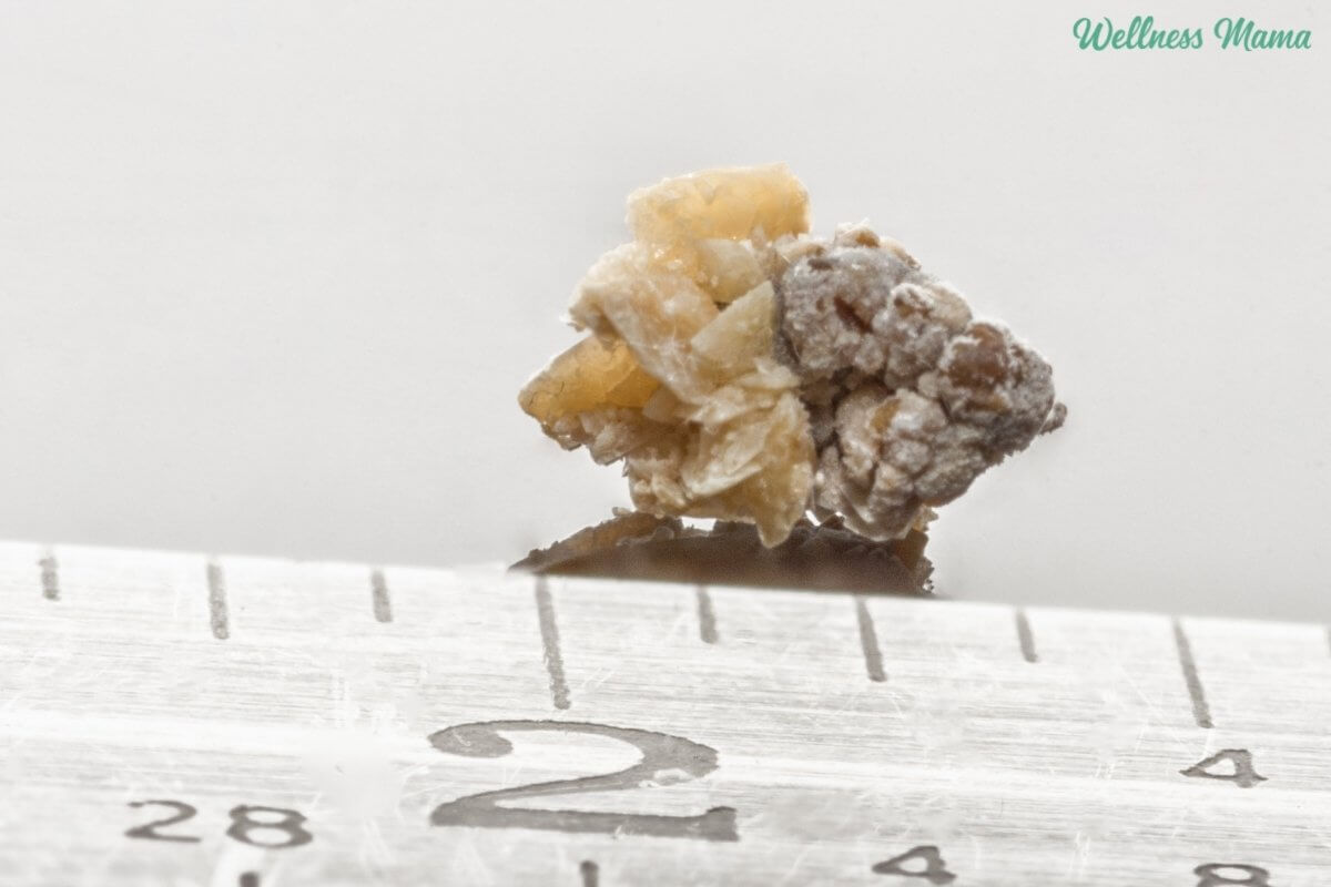 Effective Natural Remedies for Kidney Stones