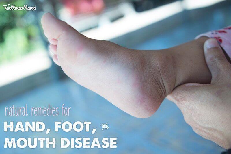 Natural Remedies for Hand, Foot, and Mouth Disease