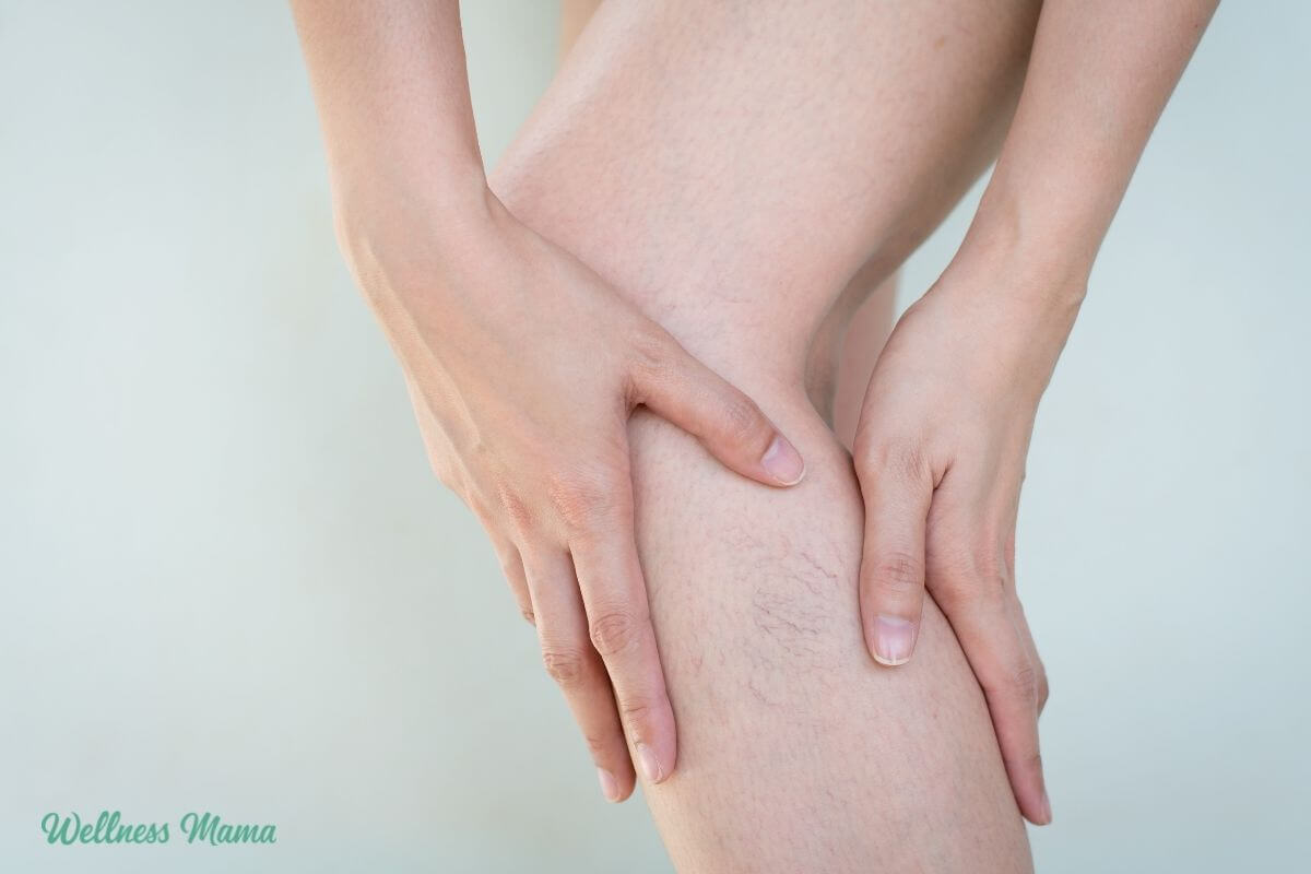 Natural Varicose Vein Remedies